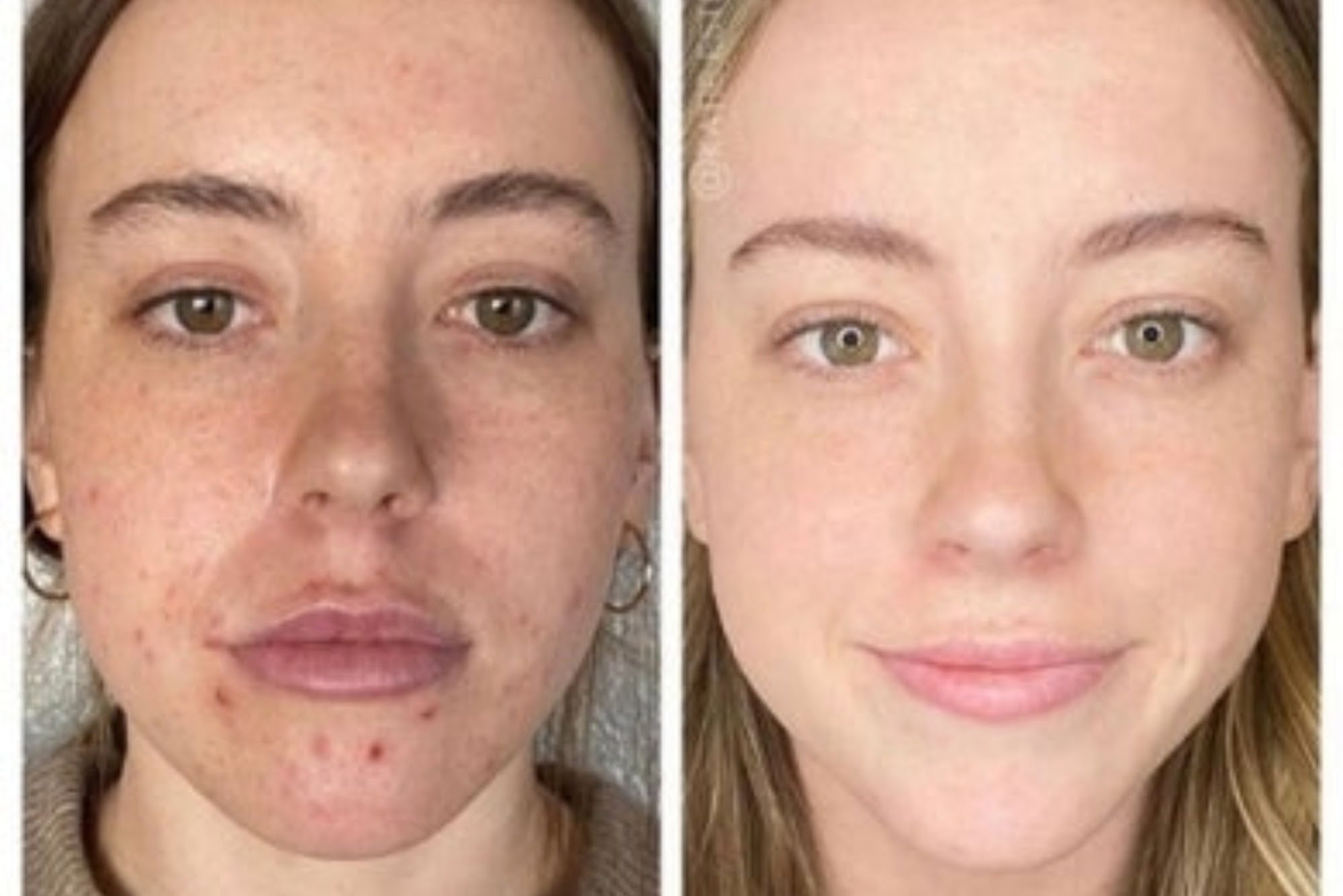 Chemical Peels Near Me