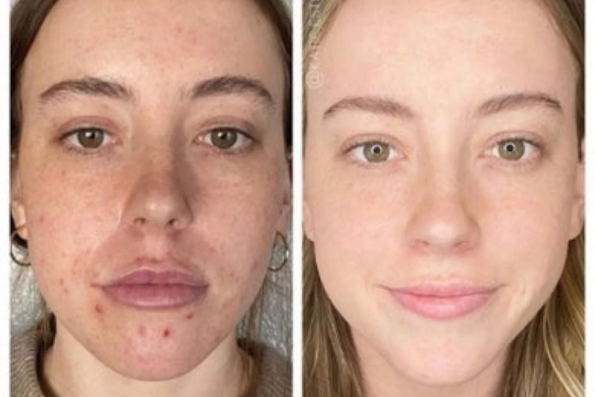 Chemical Peels Near Me